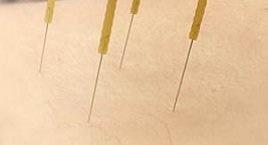 針灸痛症及常見問題