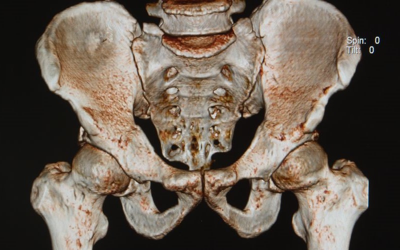 Sacroiliac joint pelvic pain