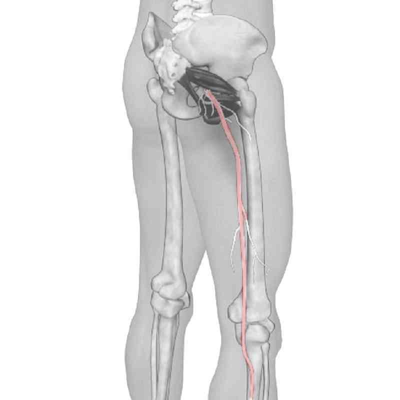 Sciatica